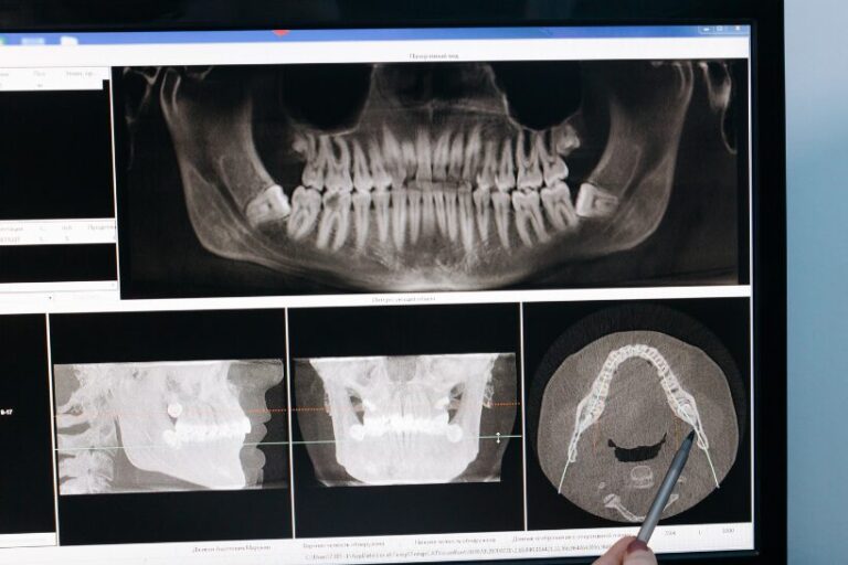 The temporomandibular joint (TMJ) is arguably the most intricate joint in the human body. Situated in front of each ear, it acts as the essential connection between the lower jaw and the skull, enabling critical functions like chewing, talking, and facial expression. While "TMJ" is the anatomical name for the temporomandibular joint, the painful condition often associated with it is correctly termed temporomandibular disorder (TMD). The difference is important: TMJ refers to the joint structure itself, whereas TMD is the medical condition. TMD is a comprehensive term for a range of problems involving the jaw joint, the surrounding muscles, and connecting tissues, which can seriously interfere with everyday activities.